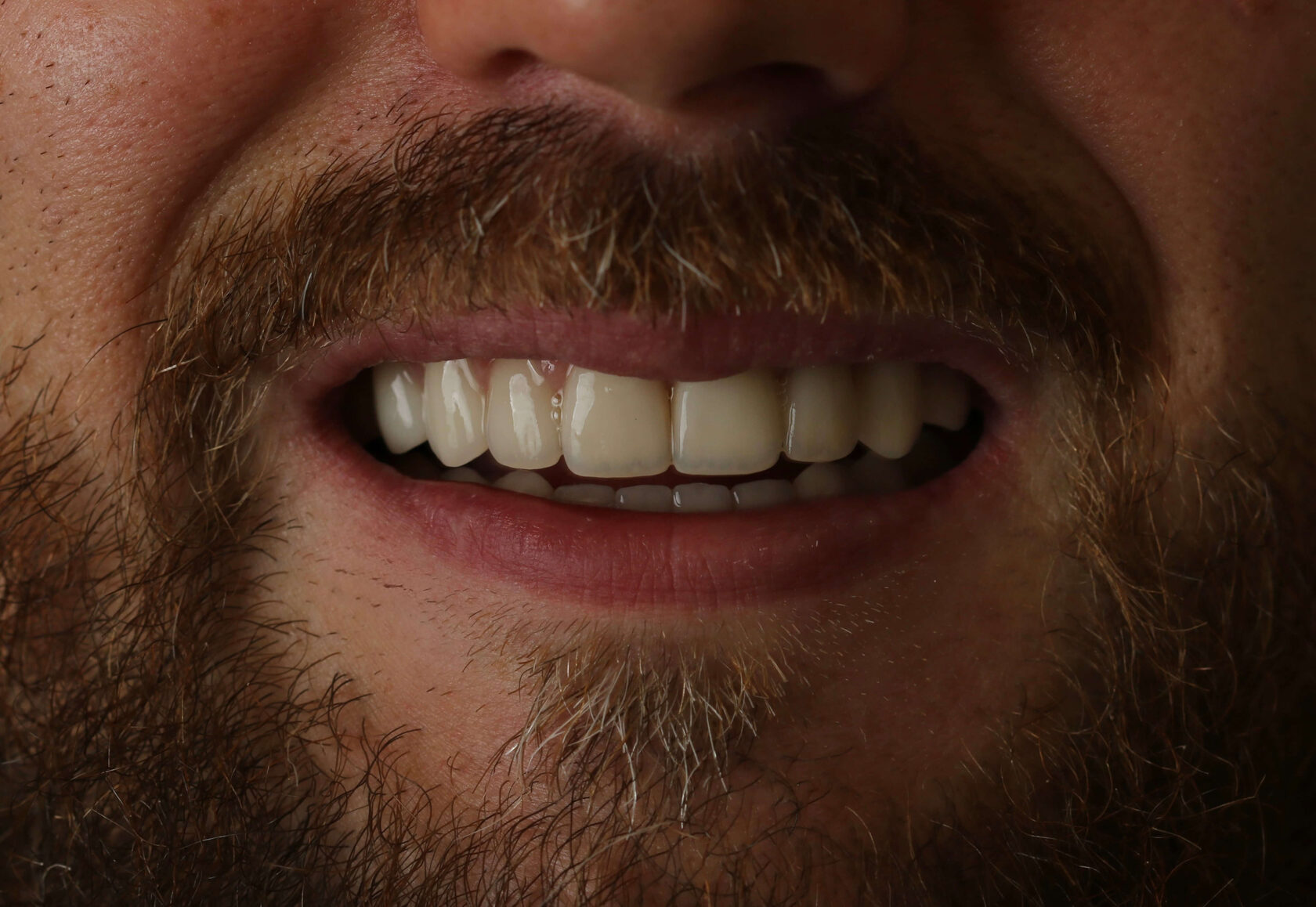 Установка и замена виниров в клинике Probel в Москве