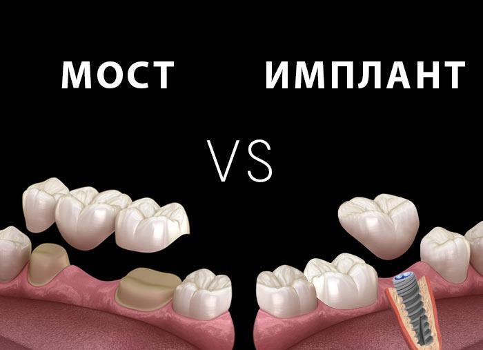 Протезирование или имплантация зубов