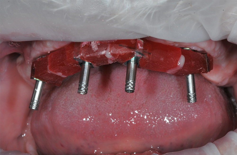 Тотальное восстановление зубов обеих челюстей