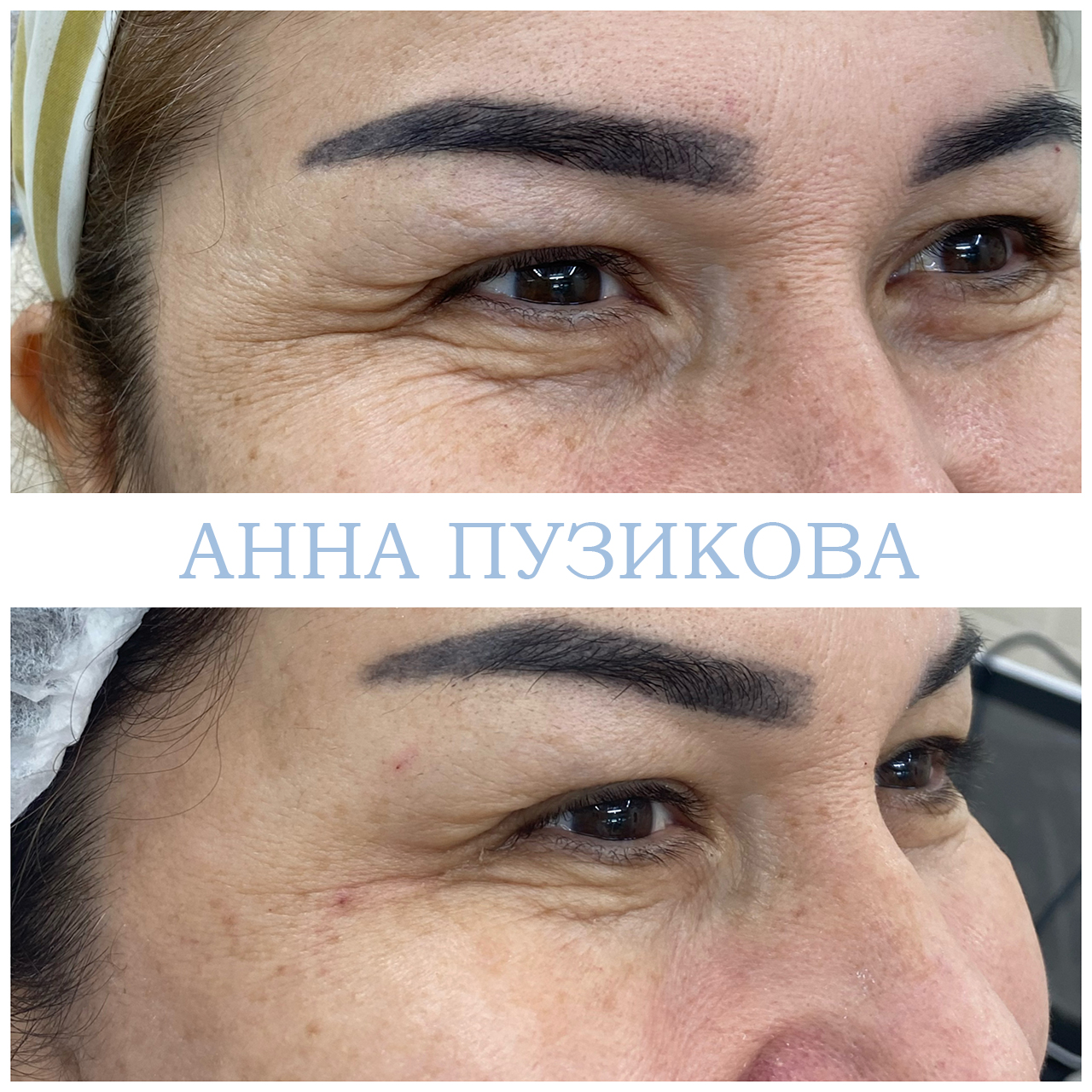 Результат ботулинотерапии — коррекция мимических морщин на лбу и в области глаз. Косметолог Пузикова Анна Анатольевна, Санкт-Петербург