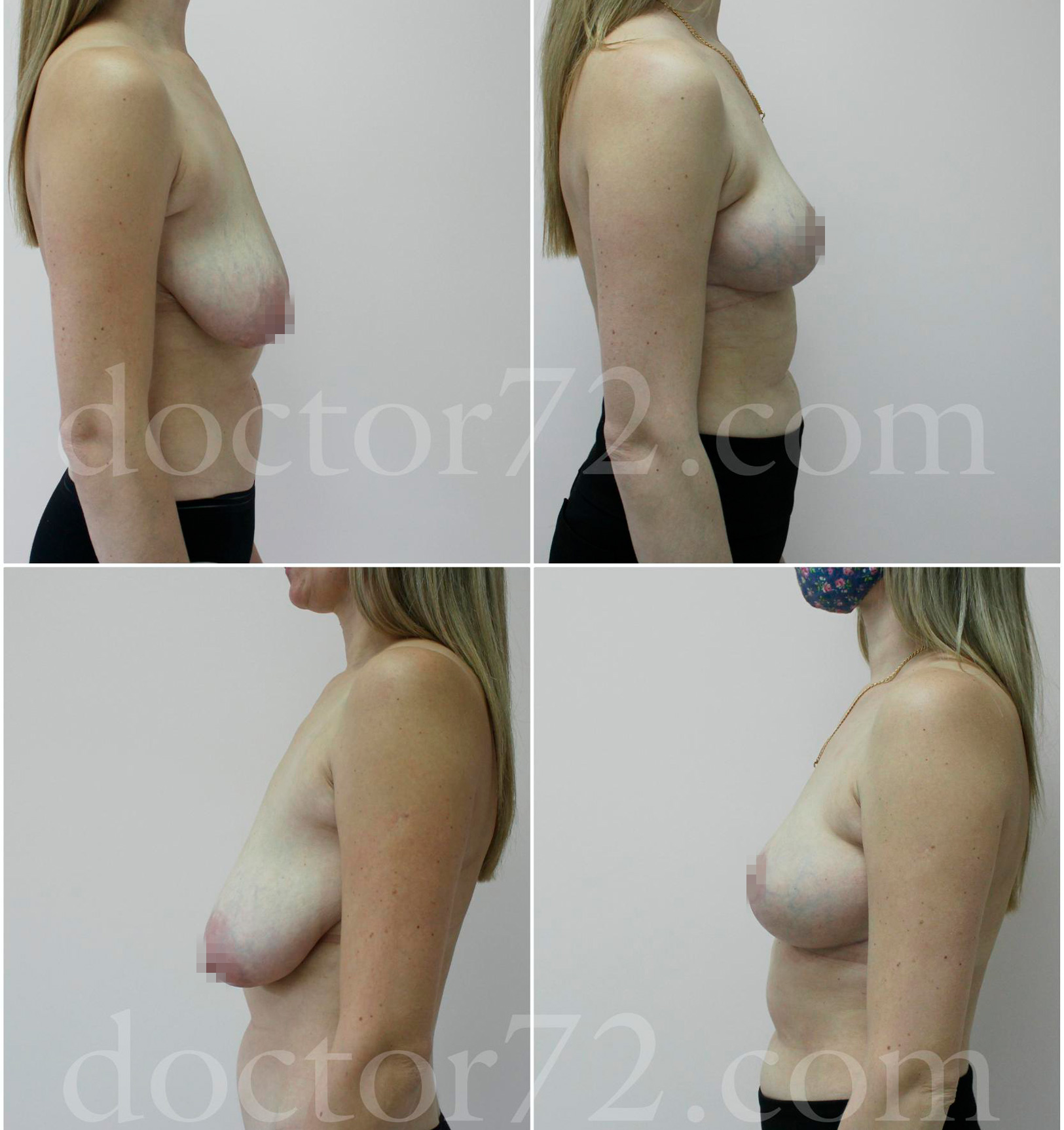 уменьшение груди при беременности фото 111