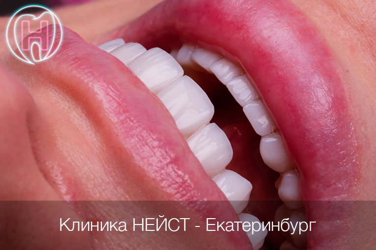 композитные виниры Премиум в Екатеринбурге, цвет Блич 2