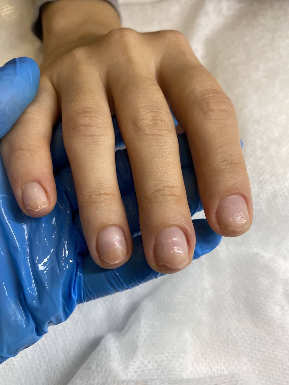 стоп онихолизис