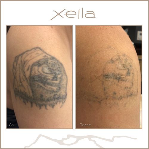 удаление тату пикосекундным лазером