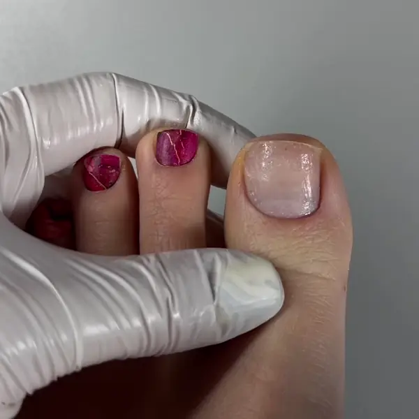 Regular Removal Step 3