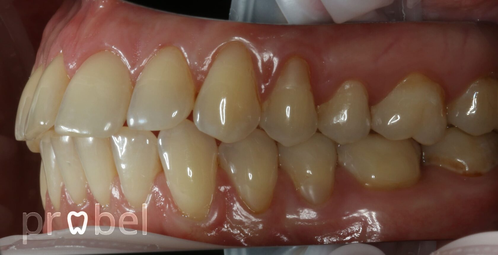 Когда нужна пластика десны – кейс из практики в стоматологии Пробел