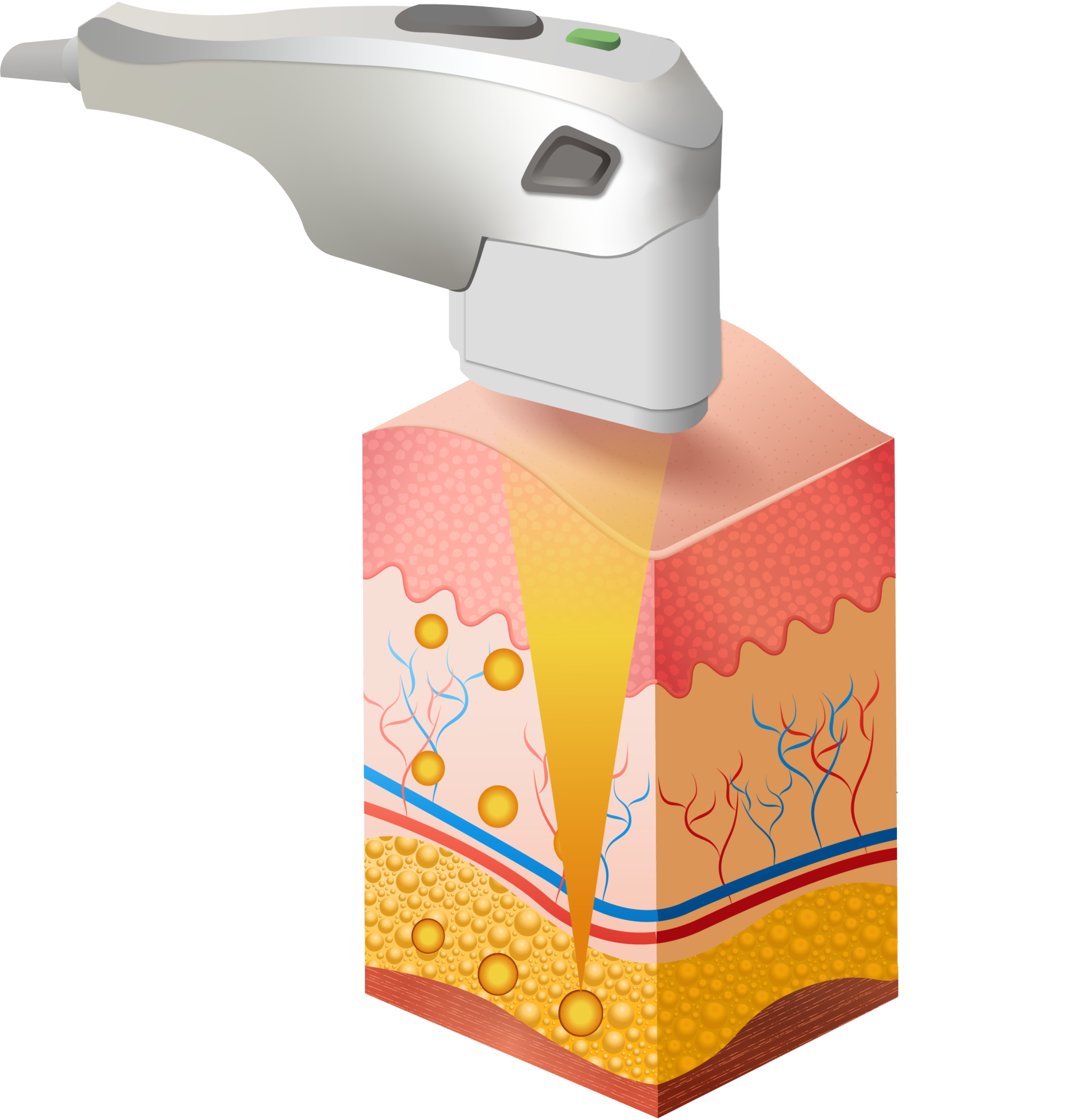 Smas лифтинг картинки