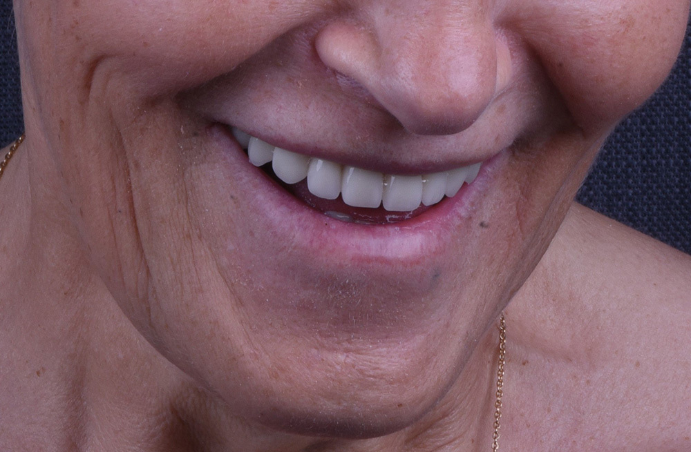 Комплексная реабилитация верхней челюсти после удаления зубов и лечения кисты