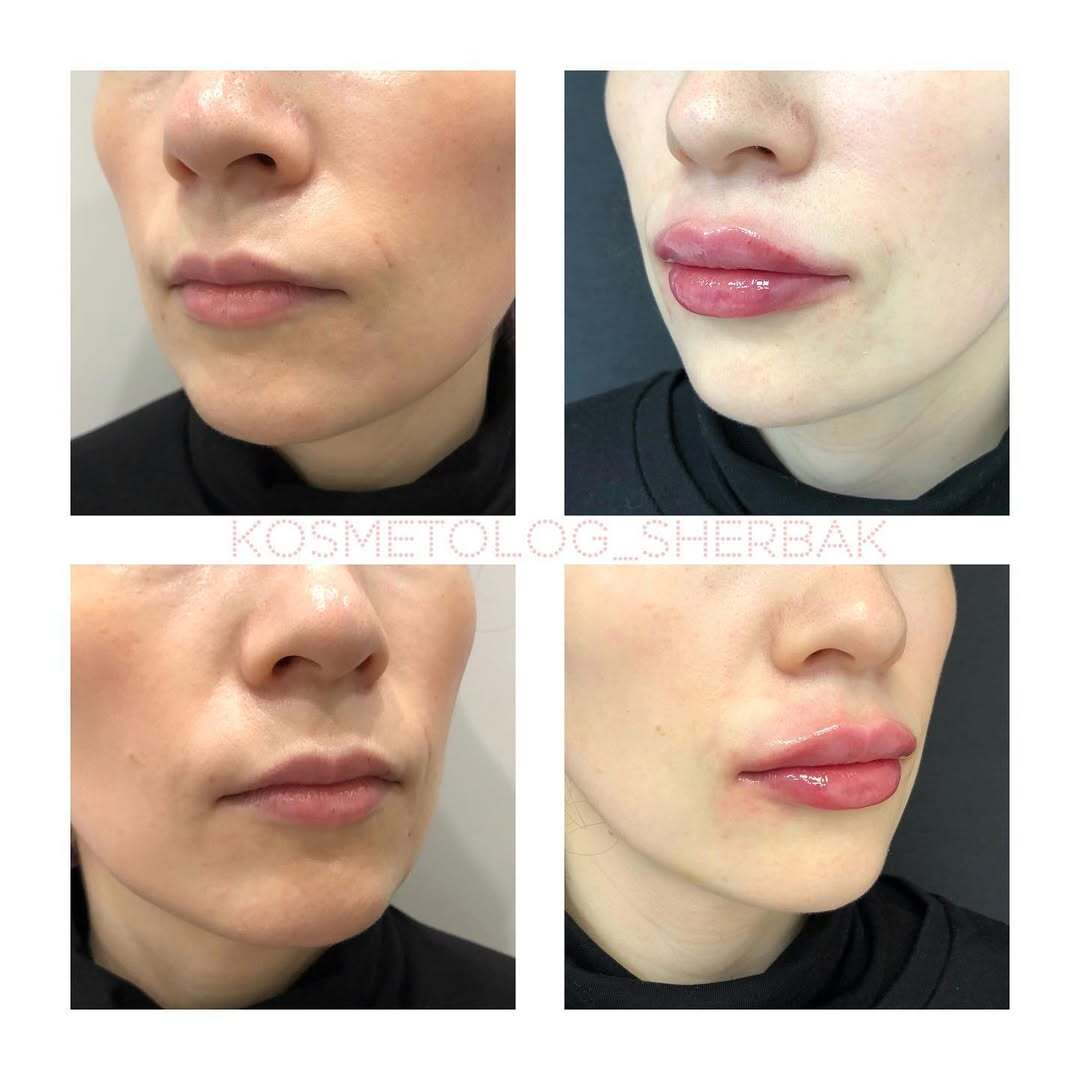 До и после контурной пластики губ. Увеличение объёма без утяжеления. PradusCOSMO, Васильевский остров