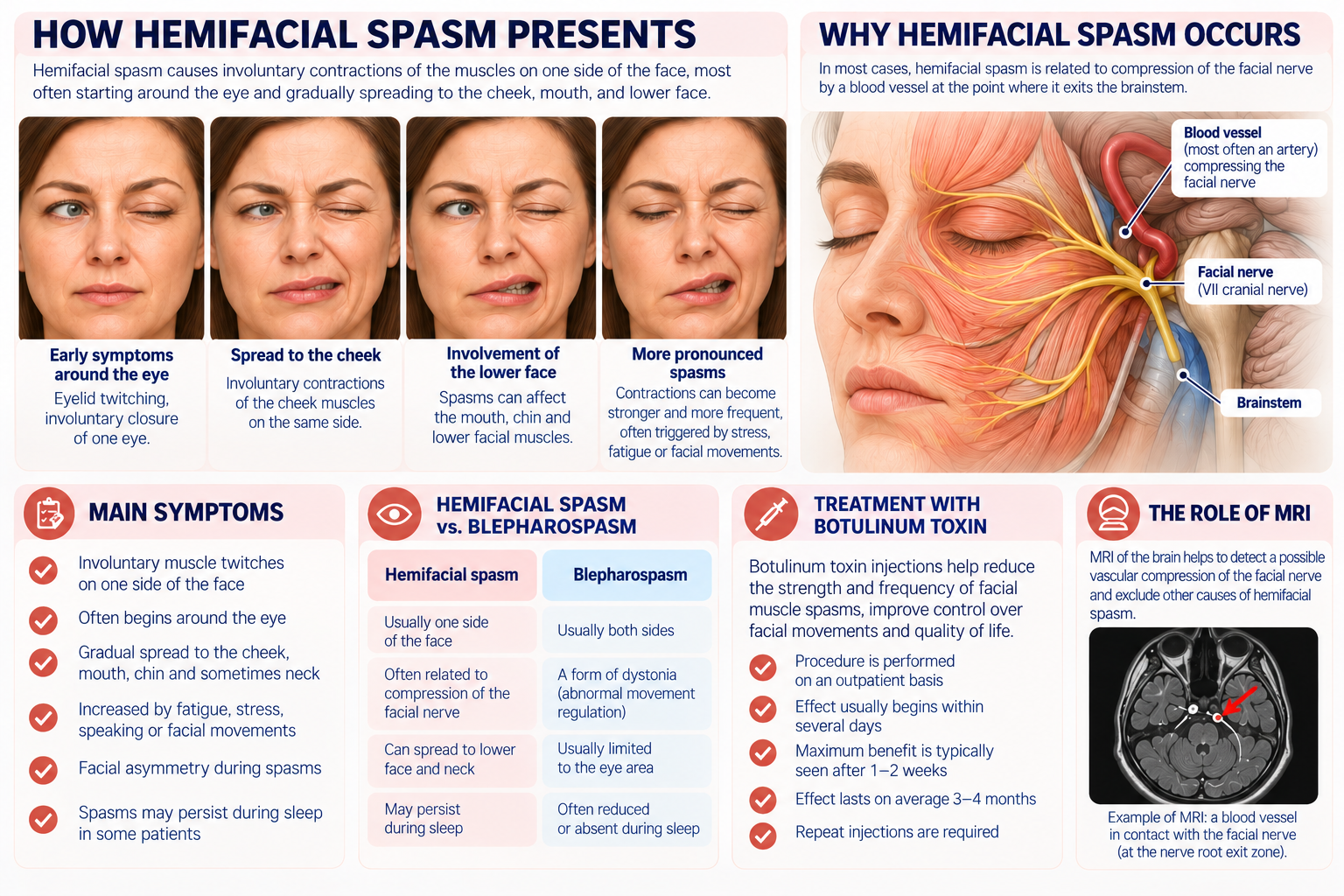 Hemifacial spasm symptoms, facial nerve, MRI and botulinum toxin treatment