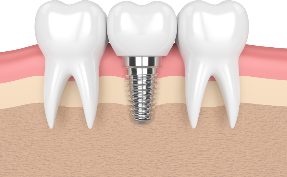 Имплант дент