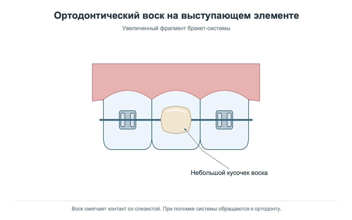 Ортодонтический воск на элементе брекет-системы