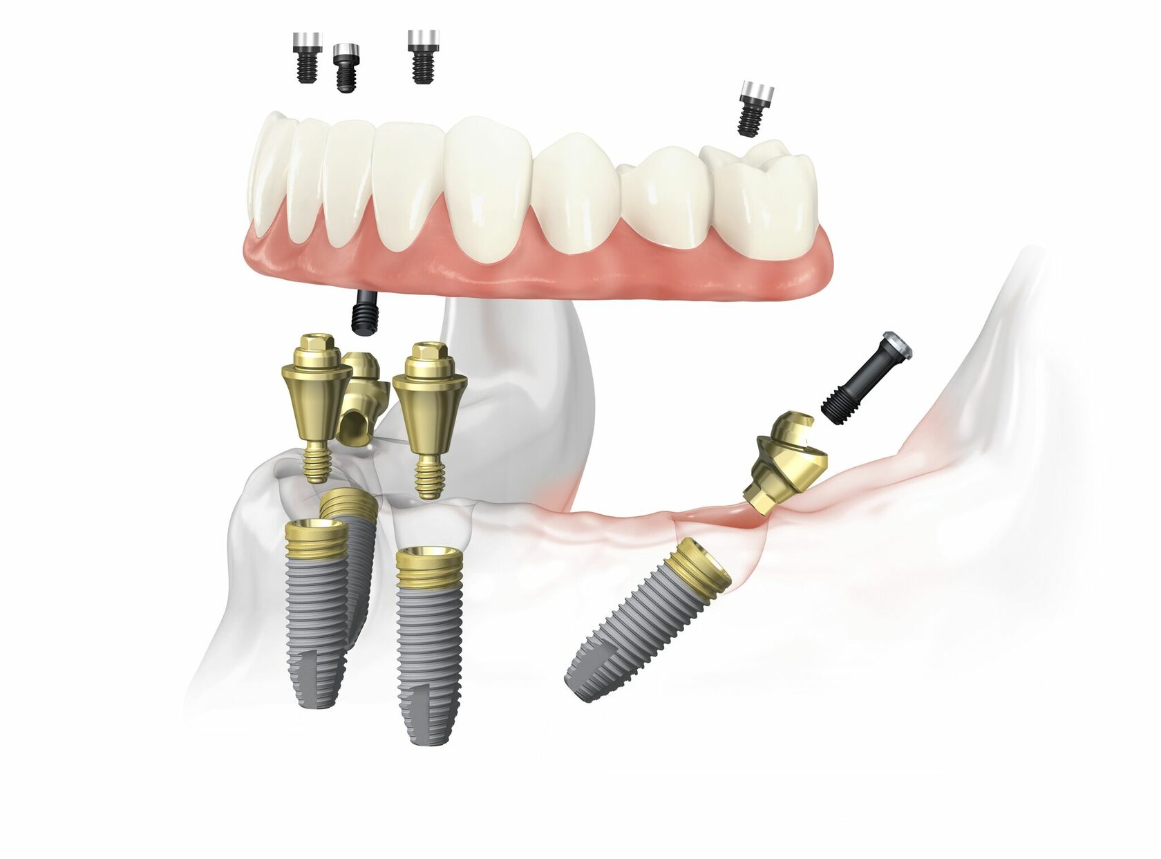 Имплантация на 4 имплантах