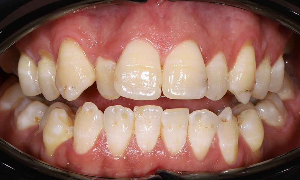 Системное ортодонтическое лечение для нормализации смыкания и положения зубов