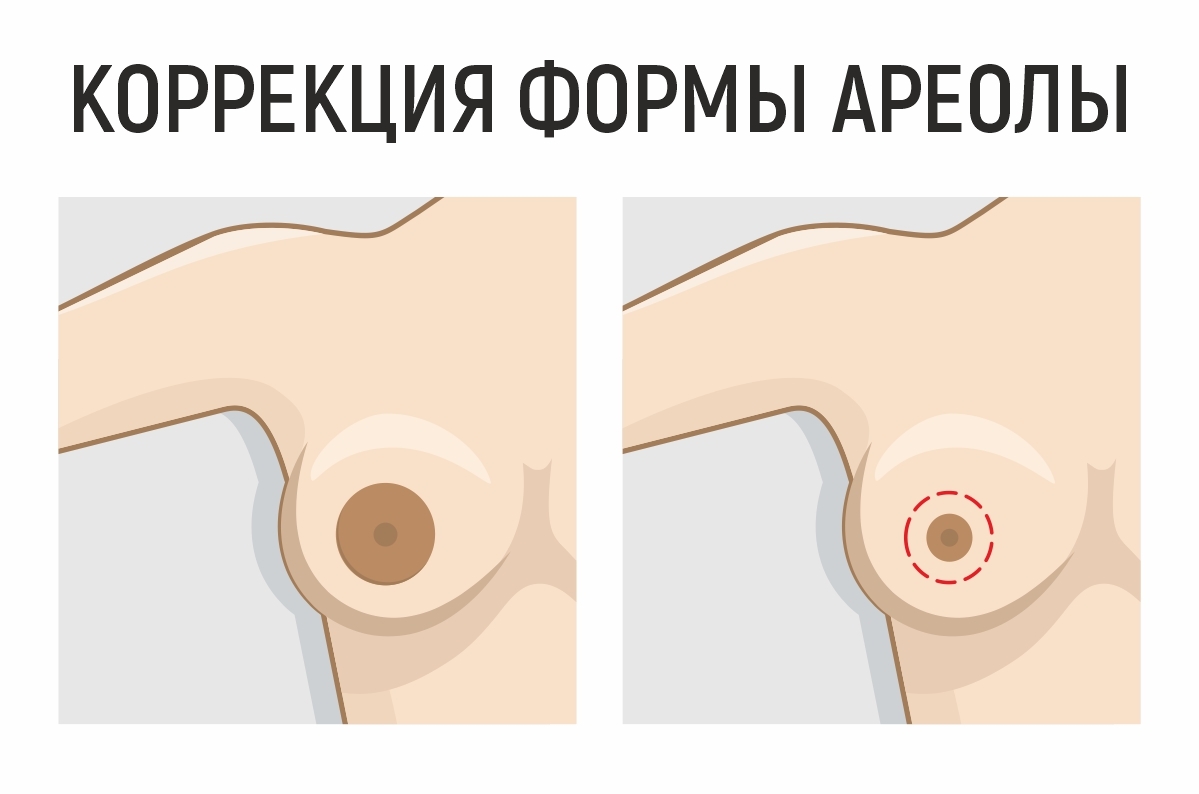 Коррекция ареолы и соска в Новосибирске по выгодной цене в клинике АвисМед