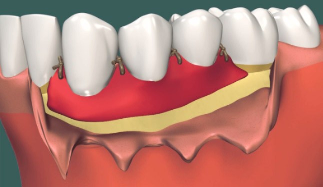 Вестибулопластика — цены в Дербенте. Стоматология DK