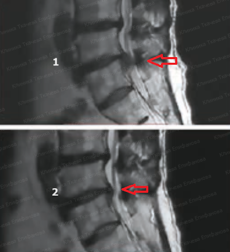 Секвестрация грыжи позвоночника - причины, симптомы, лечение в Санкт-Петербурге (СПб)