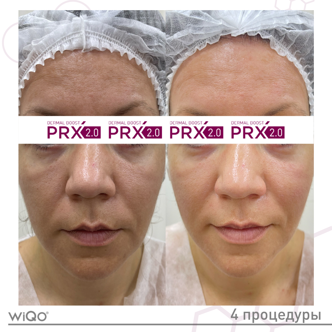 Prx пилинг состав. Протокол пилинга prx 33. пилинги prx-t33. пилинг prx-t33 эффект от процедуры.