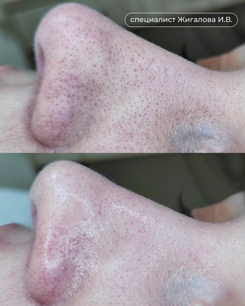 Hydrafacial - До и после