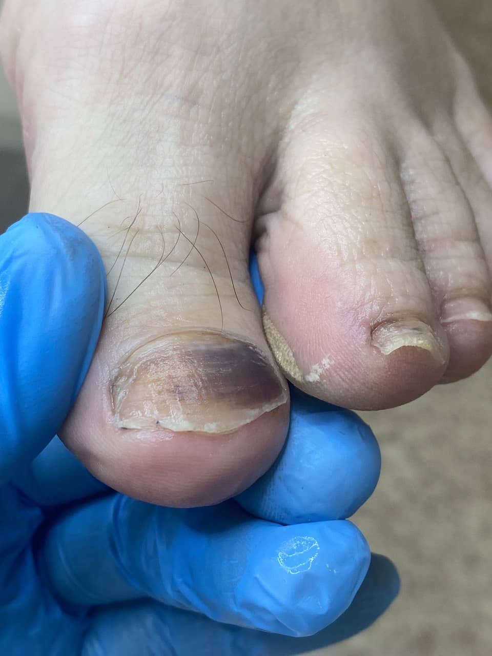 ноготь после травмы