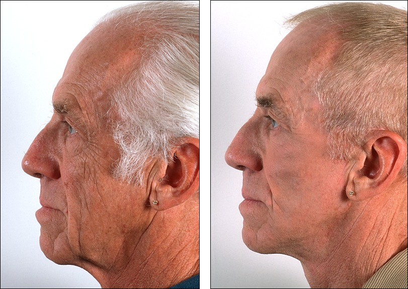 Подтяжка лица у мужчин до и после фото