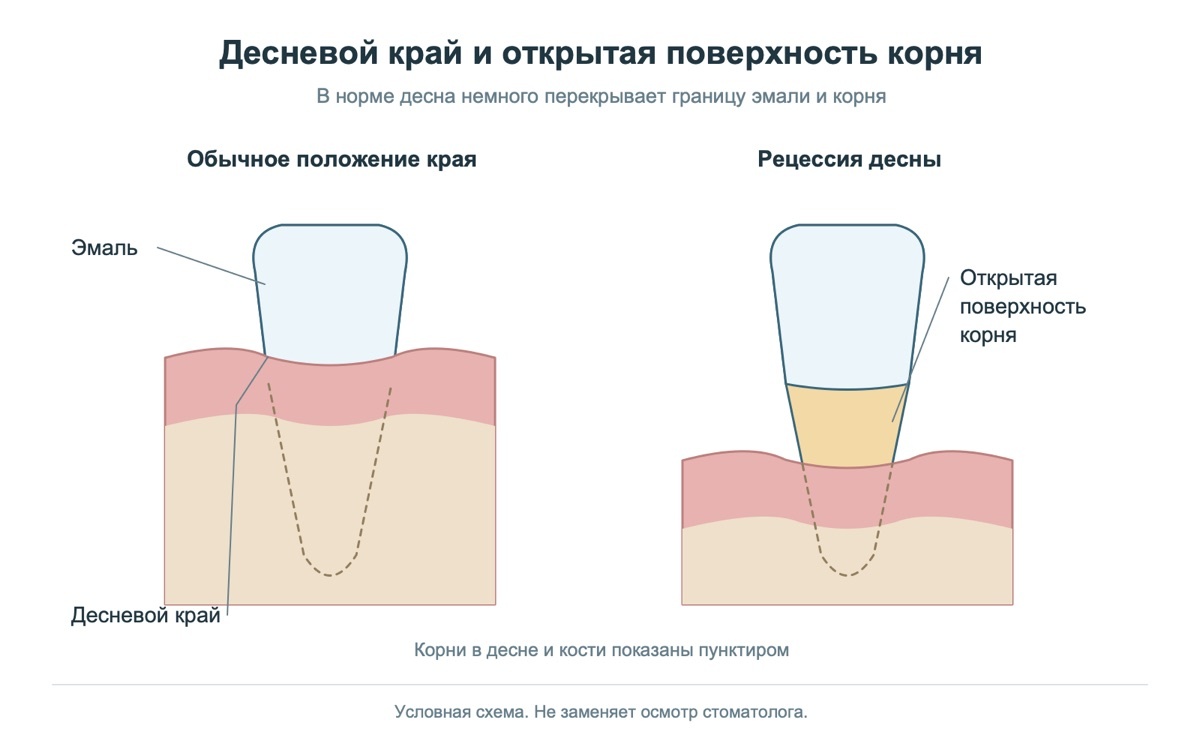 Десневой край в норме и при рецессии: открытая поверхность корня