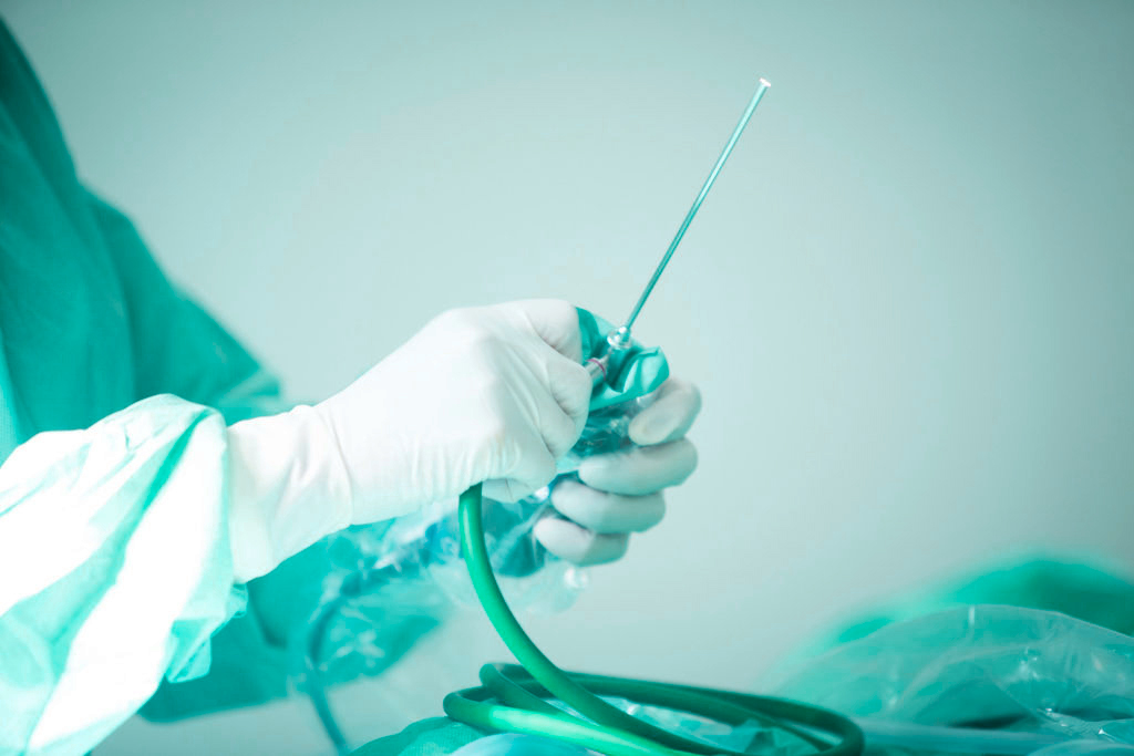 Виды свищей прямой кишки