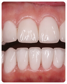 Имплантация зубов в стоматологии Дент-Арт