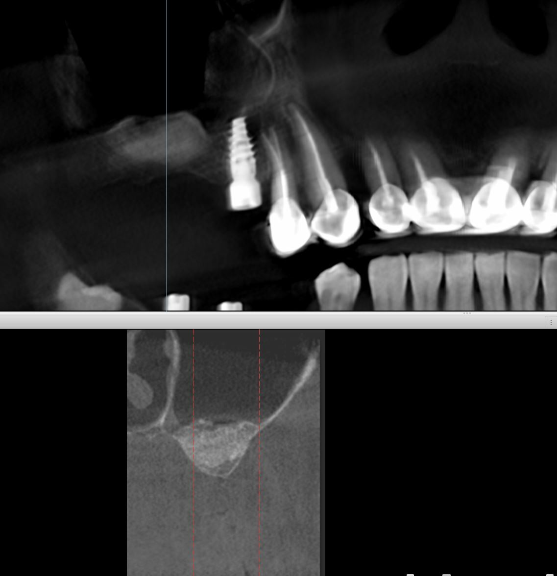 Синус-лифтинг