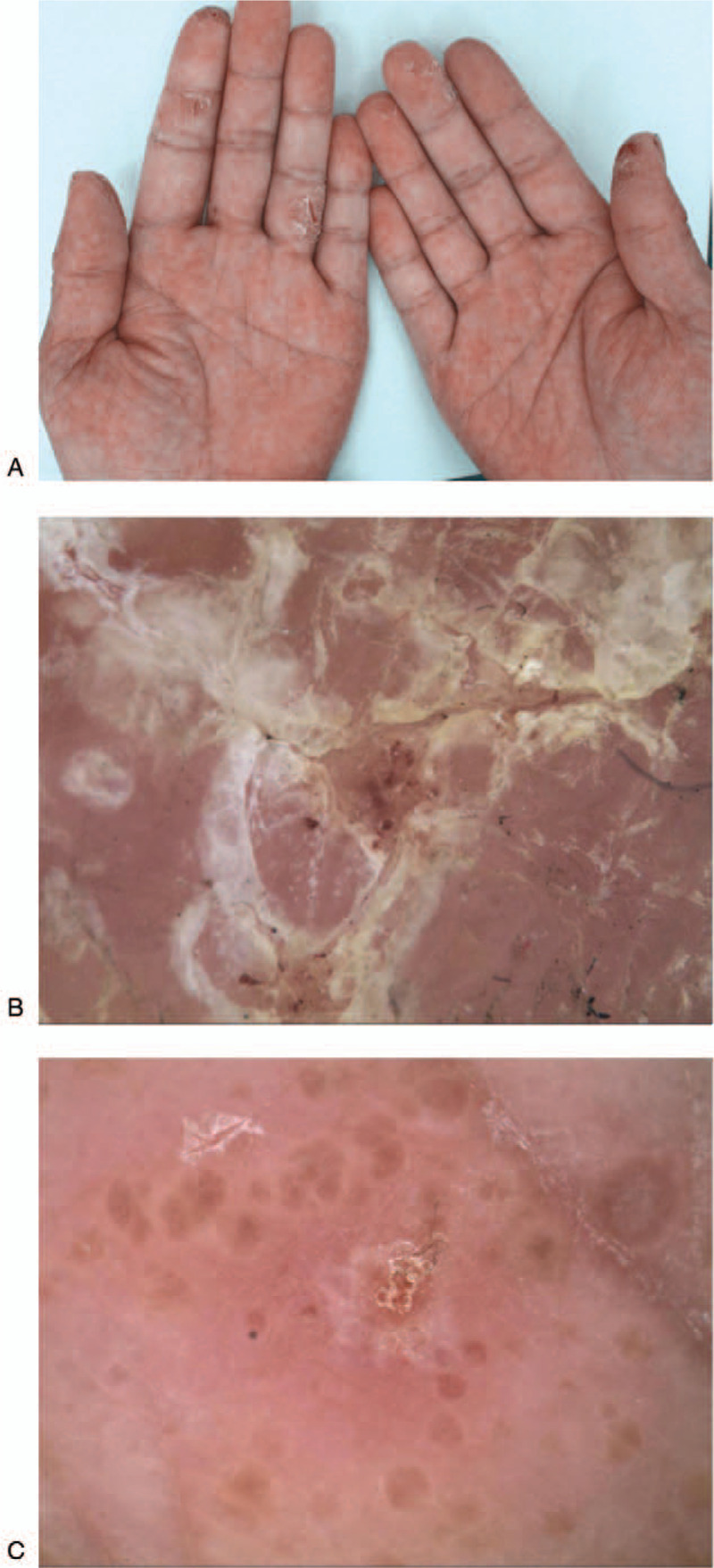 Дифференциальная диагностика между псориазом и экземой ладоней и подошв