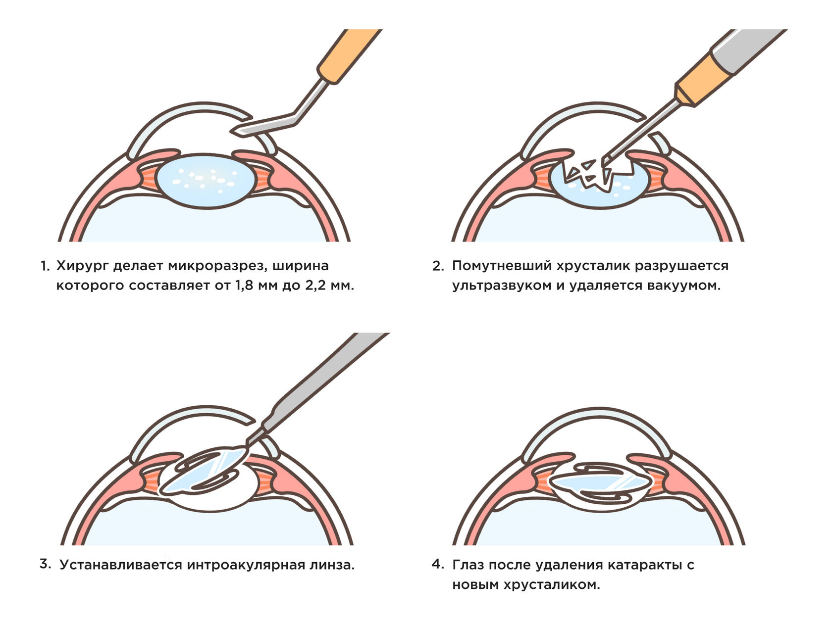 Название операции по удалению катаракты. Как делают операцию по удалению глаукомы. Операция на глаза подшивание кольцо.
