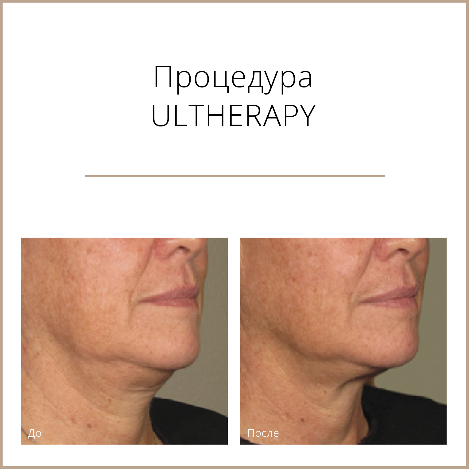 Ultherapy аппарат