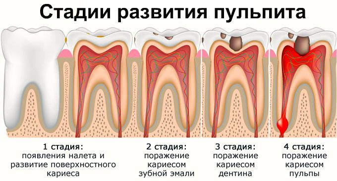 Пульпит презентация по стоматологии