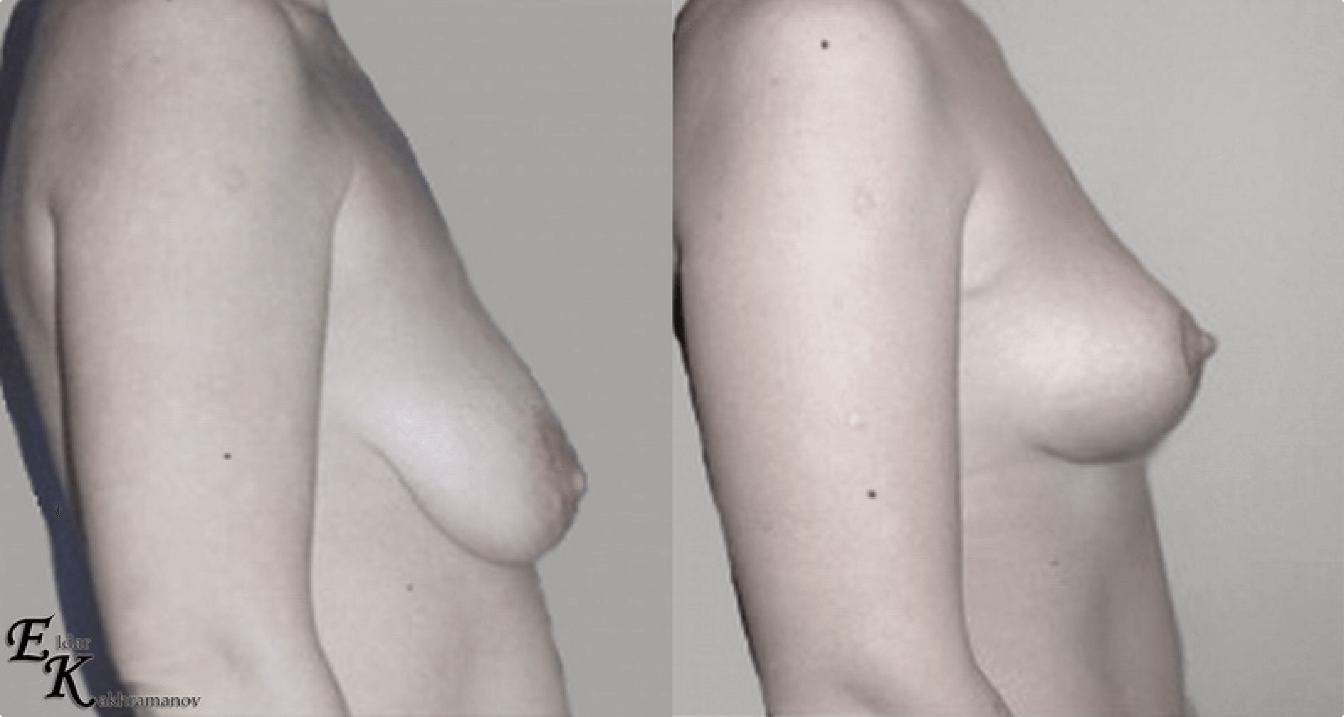 разновидности груди женщин фото 108