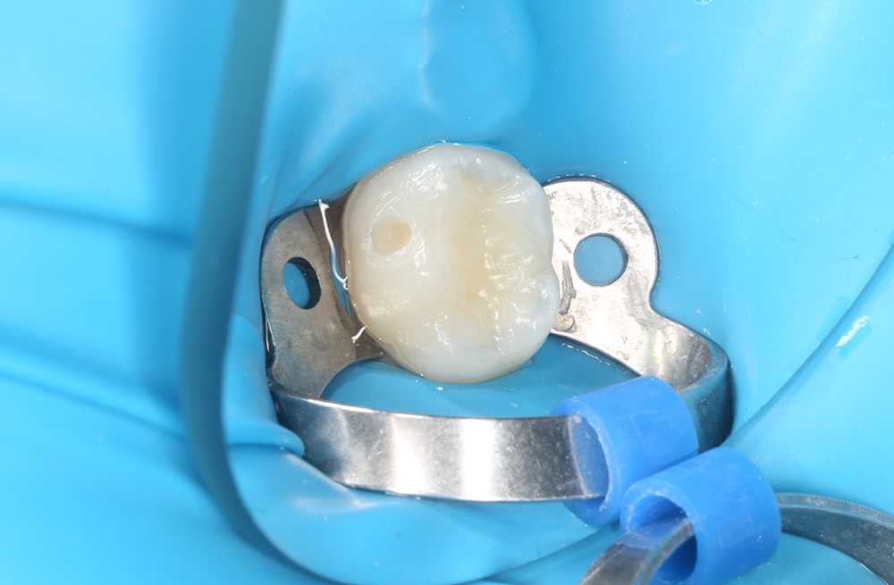 Случай раннего лечения кариеса без жалоб у ребёнка с последующей санацией полости рта