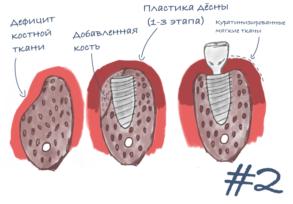 Имплантация костной ткани