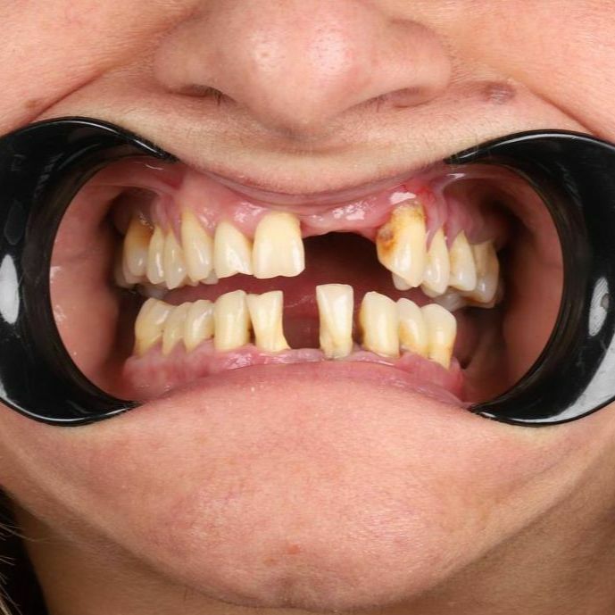 All-on-4, All-in-4 имплантация, протезирование, вернуть зубы, протезирование на имплантах, всё-на-4, все-на-четырех, протезирование зубов