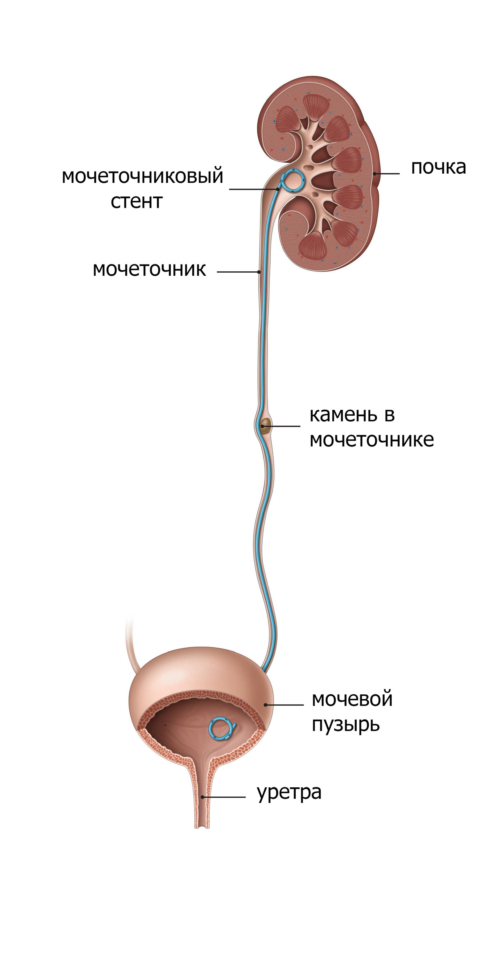 Камень в мочеточнике у мужчин. Стент в почке и камень в мочеточнике. Гидронефроз стент почки. Стенд из почки в мочеточник.