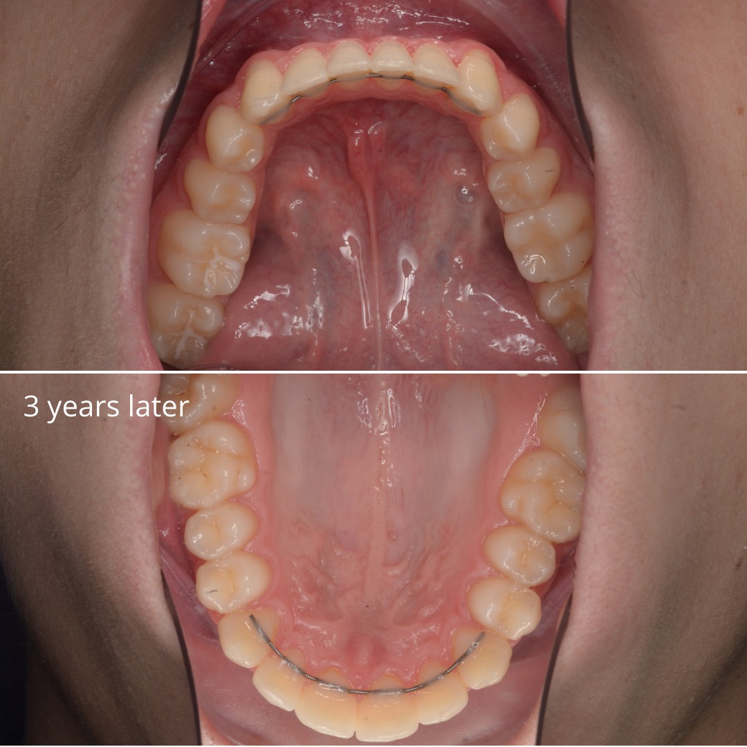After treatment and three years later: stable, corrected occlusion and arch form — photo 6 of 6