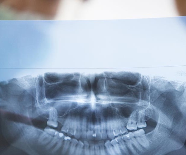 рентген в стоматологии