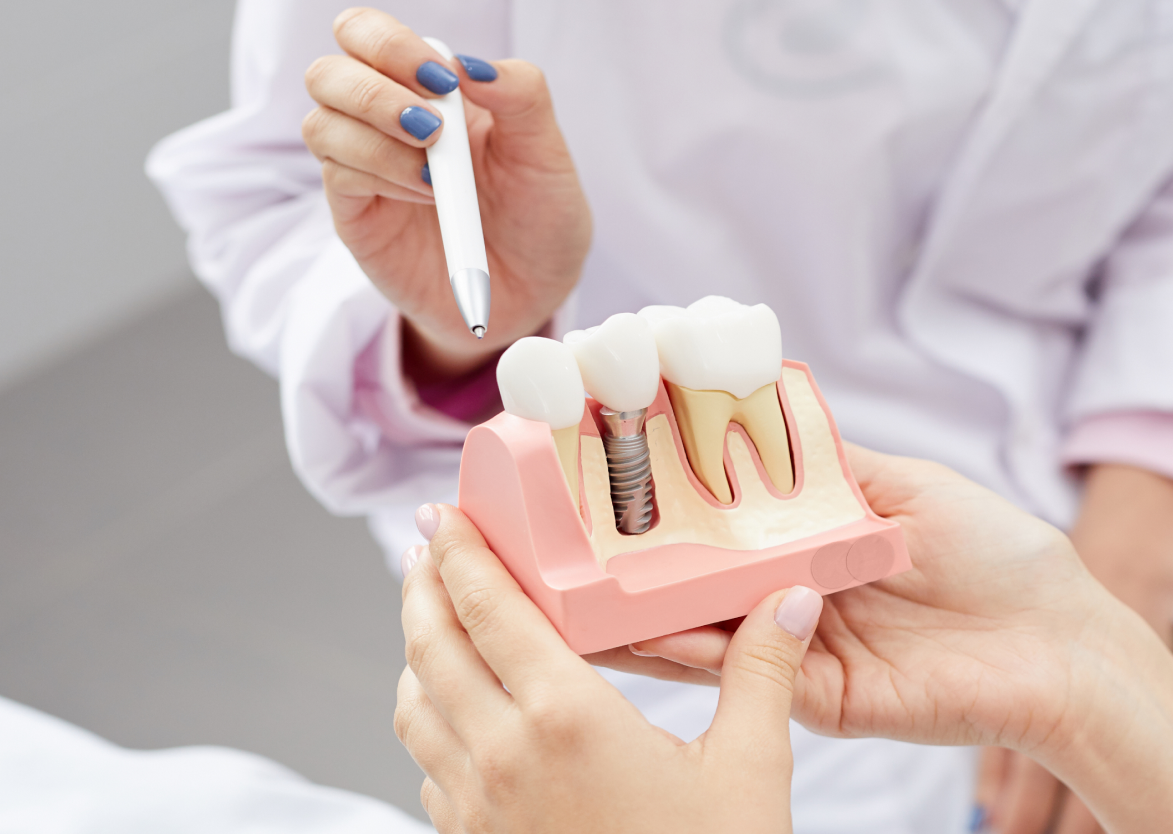 имплантат. корея). имплант osstem. имплантация нижний тагил. внутрикостная дентальная имплантация osstem.