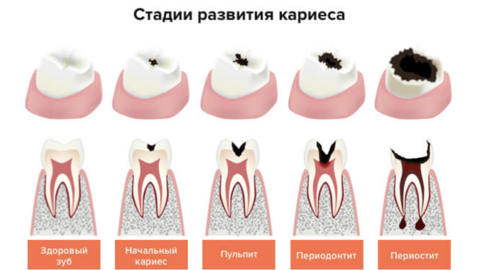 Степень разрушения зуба. Начальная стадия кариеса.