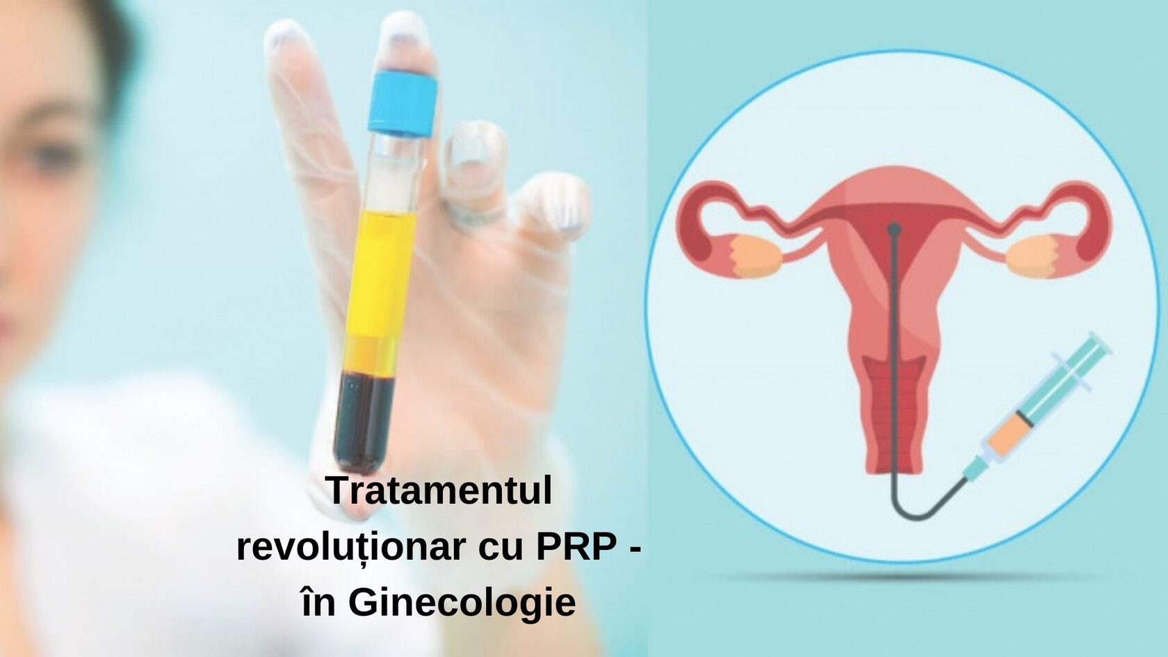 Плазма в гинекологии. PRP плазмотерапия. PRP-терапия (Platelet Rich Plasma). Плазмолифтинг и PRP В гинекологии. PRP терапия + плексатрон.