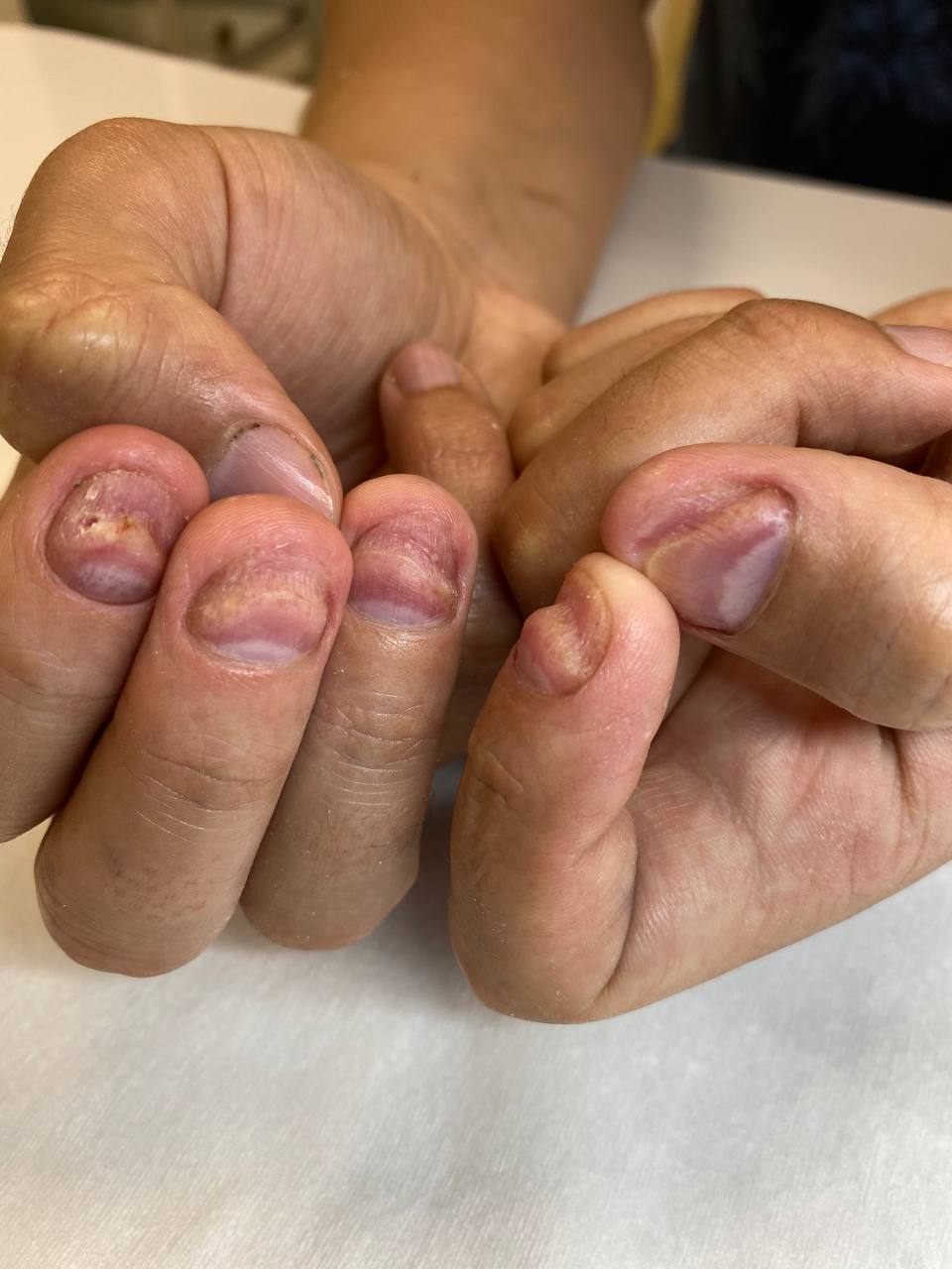 Псориаз ногтей