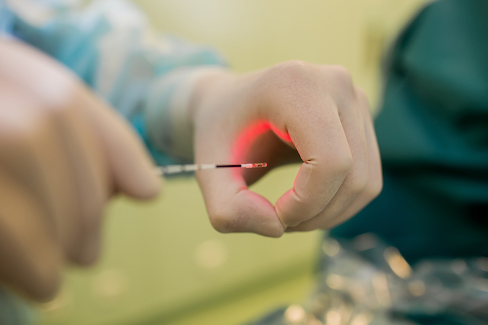 Radiálne laserové vlákno používané pri endovenóznej laserovej ablácie EVLA