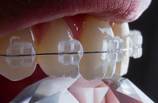 Что такое пластиковые брекеты?