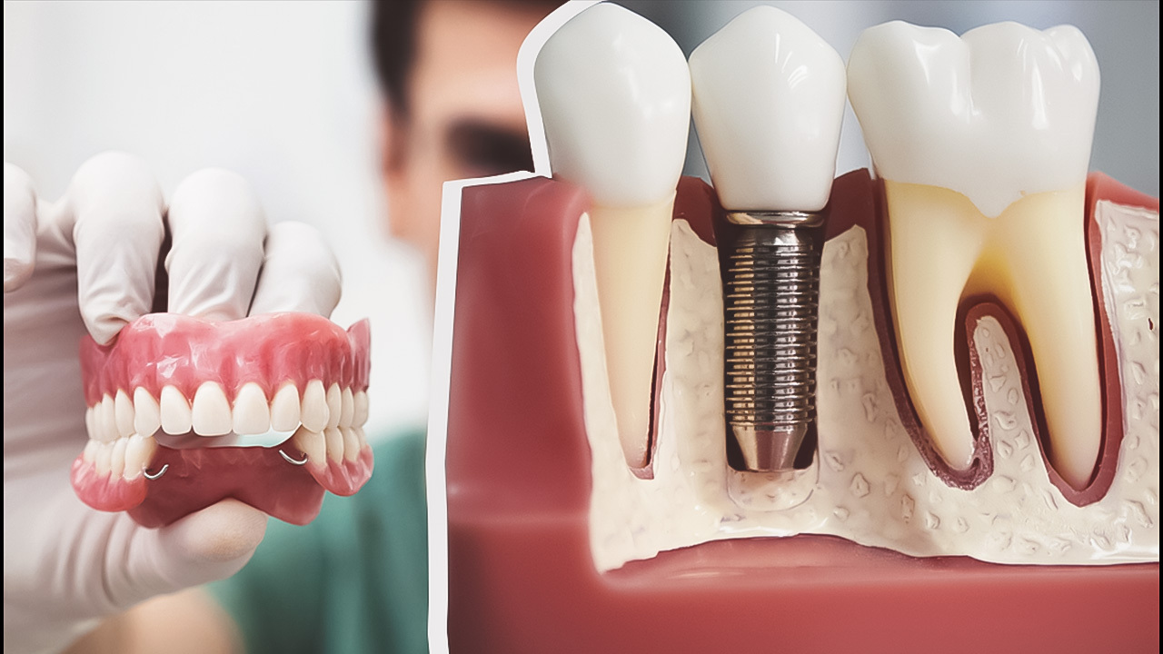 Как называется протезист. Современная имплантация зубов. Зубные протезы импланты.