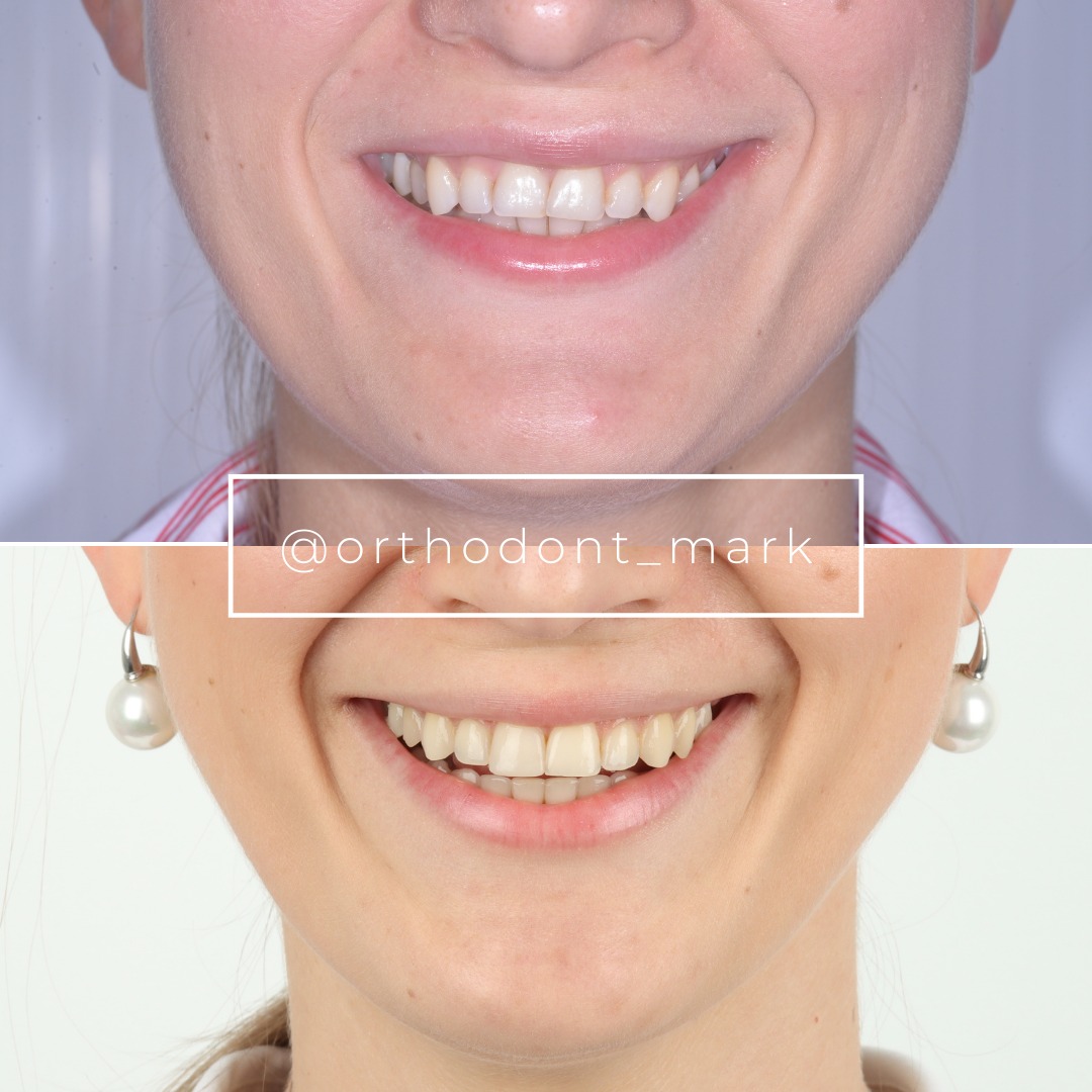 TAD-Assisted Intrusion for Smile Arc Symmetry