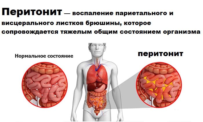 Стол при паховой грыже