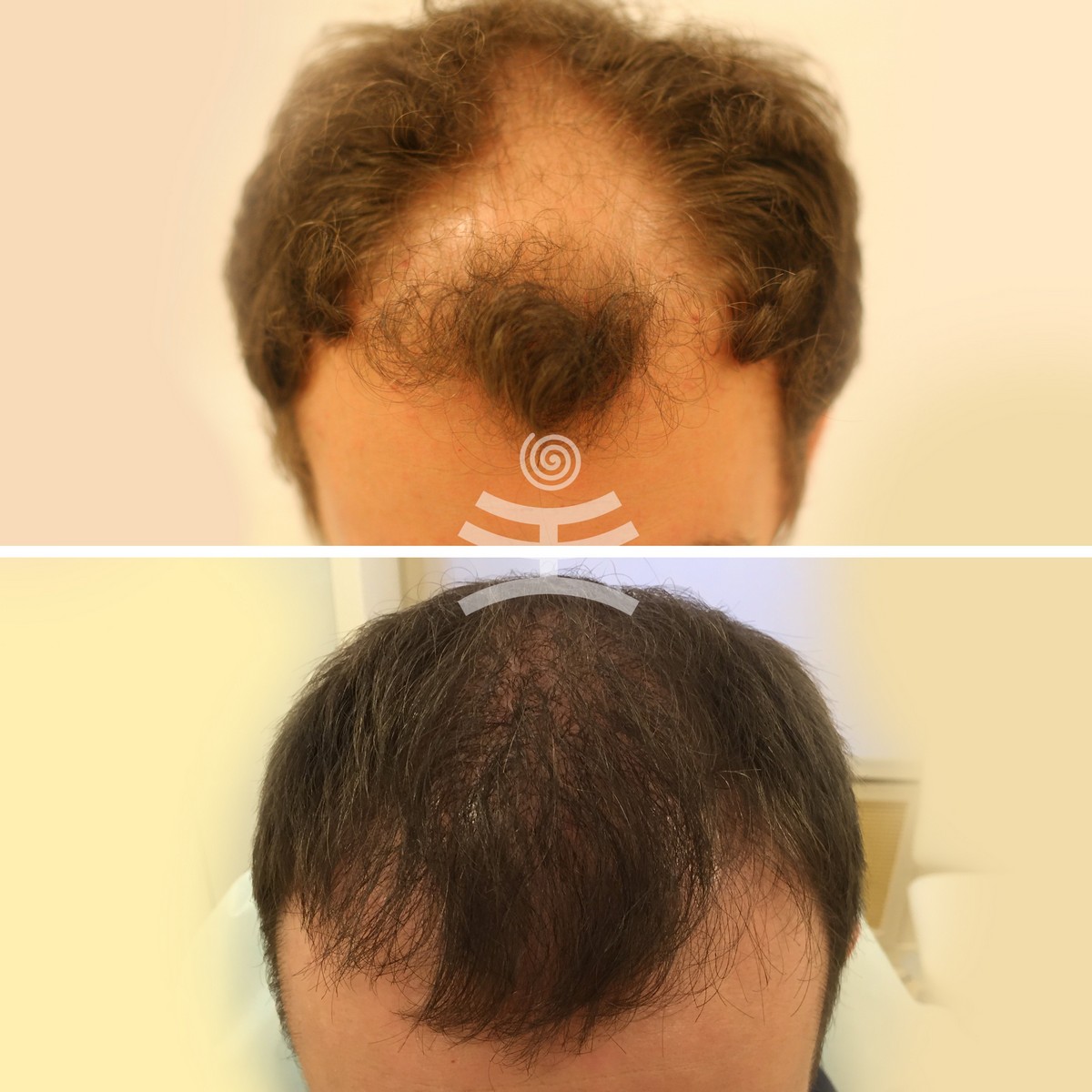 Мезотерапия для волос от выпадения у мужчин фото до и после